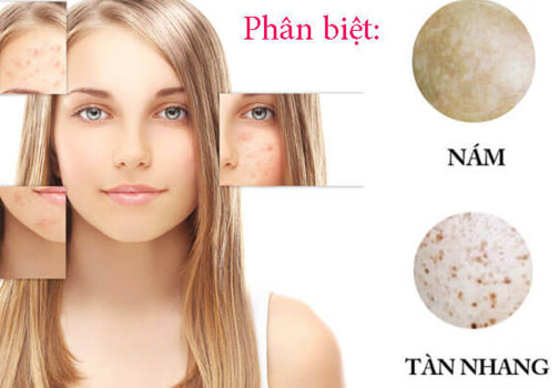 Cách Phân Biệt Nám Và Tàn Nhang