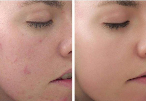 Peel da là gì và những điều cần biết